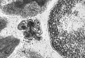 M,3y. | mast cell - granules with scroll-like formations - n. suralis, Krabbe globoid leukodystrophy